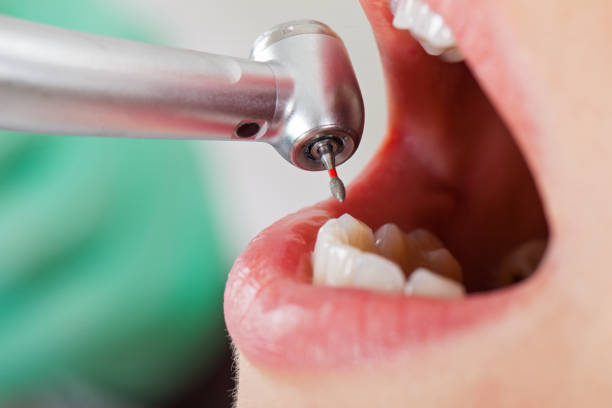 Best Emergency Root Canal Treatment in Dewitt, AR